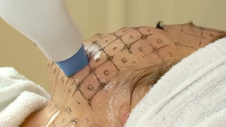 サーマクールCPT 実際の治療の様子