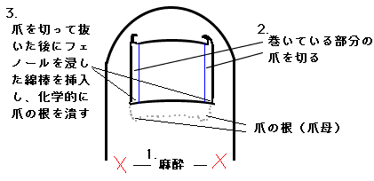 まき爪（陥入爪）の治療 イメージ図