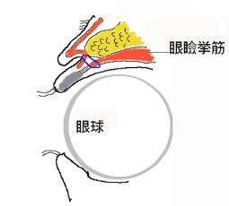 埋没法による二重まぶた手術 イメージ図