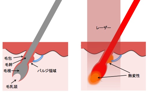 レーザーによる脱毛のイメージ図