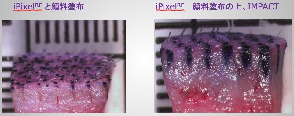 薬剤浸透