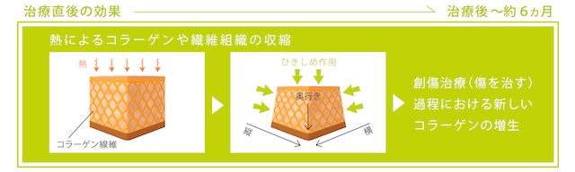 サーマクールによる治療 熱によるコラーゲンや繊維組織の収縮のイメージ