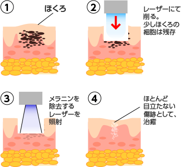 ほくろ 除去